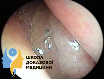 Поліп середнього носового ходу