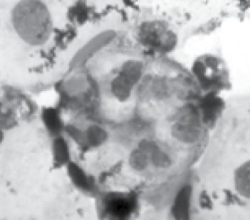 Макрофаг, який містить у собі нейтрофільні лейкоцити в препараті крипт НМ. Забарвлення за Паппенгеймом, х1000