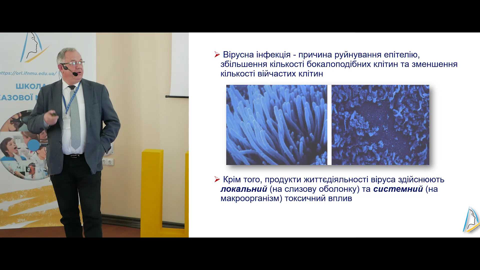 Післявірусний риносинусит та розвиток бактеріальної інфекції