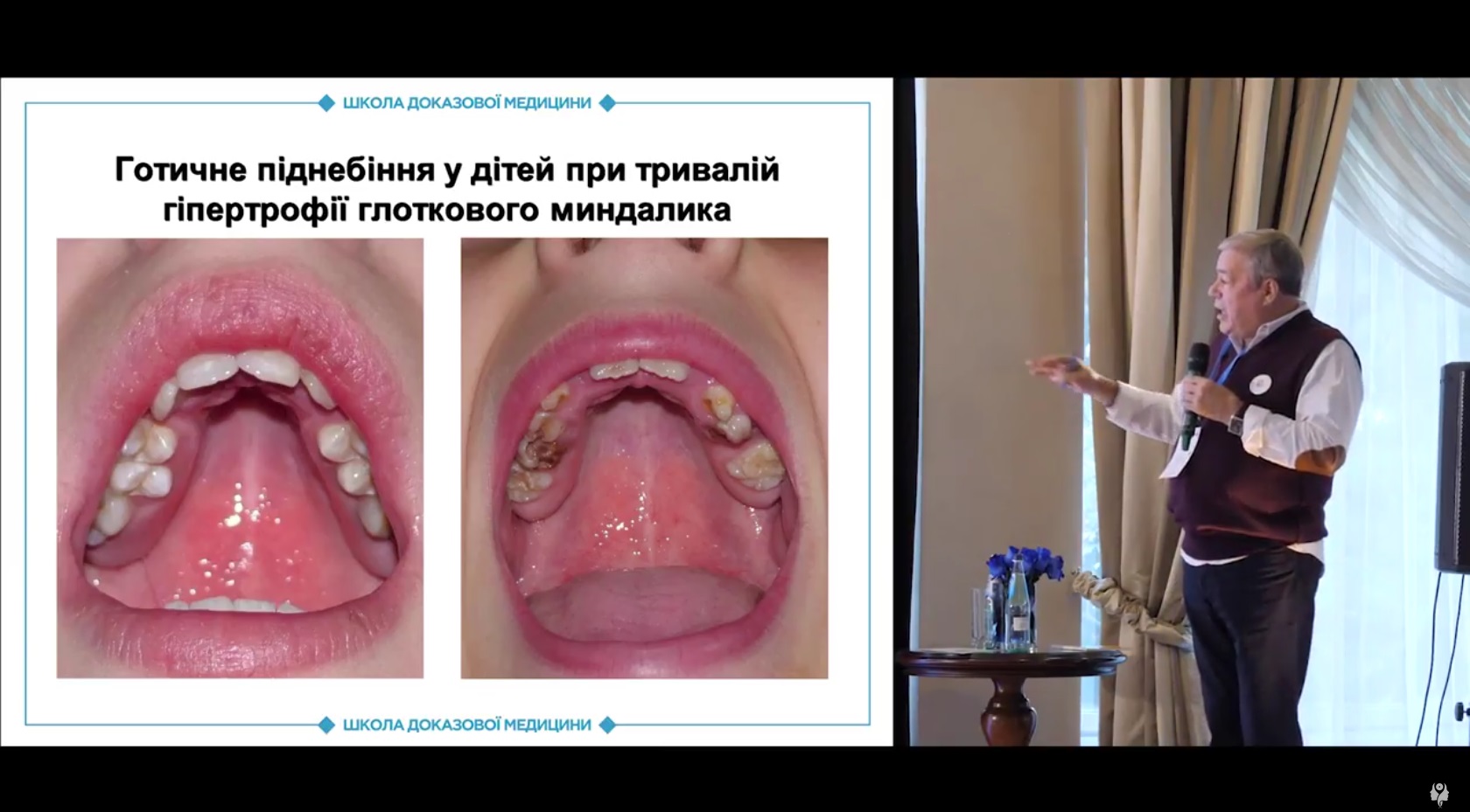 Показання до аденоїдектомії