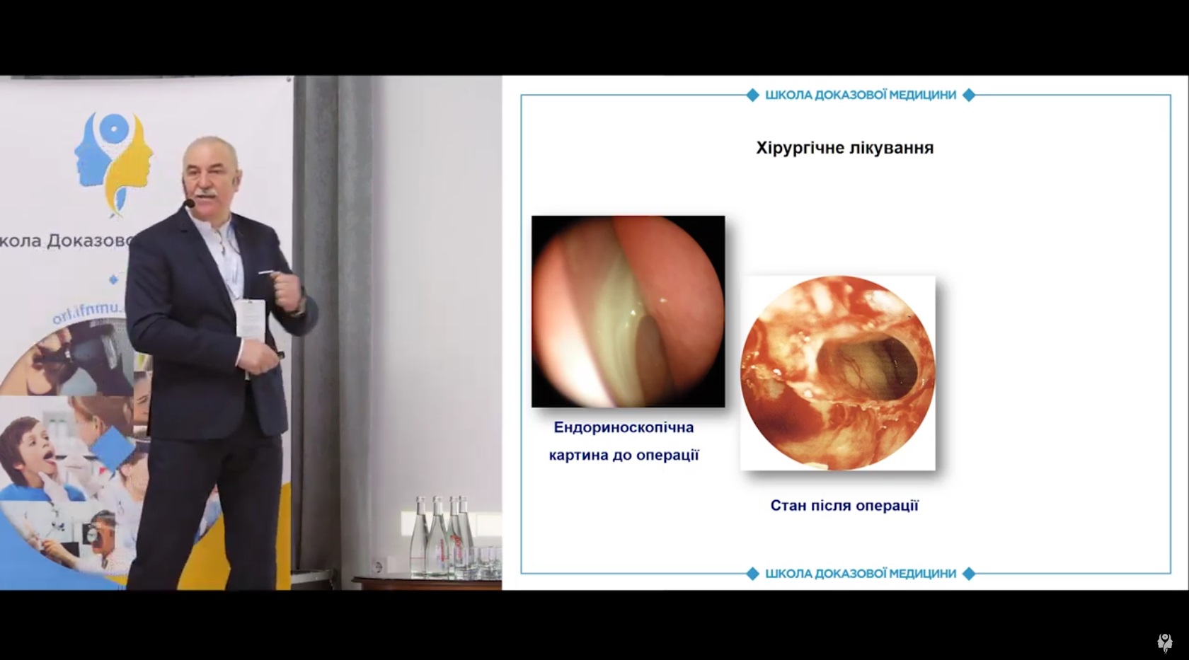 Функціональна ендоскопічна хірургія пазух