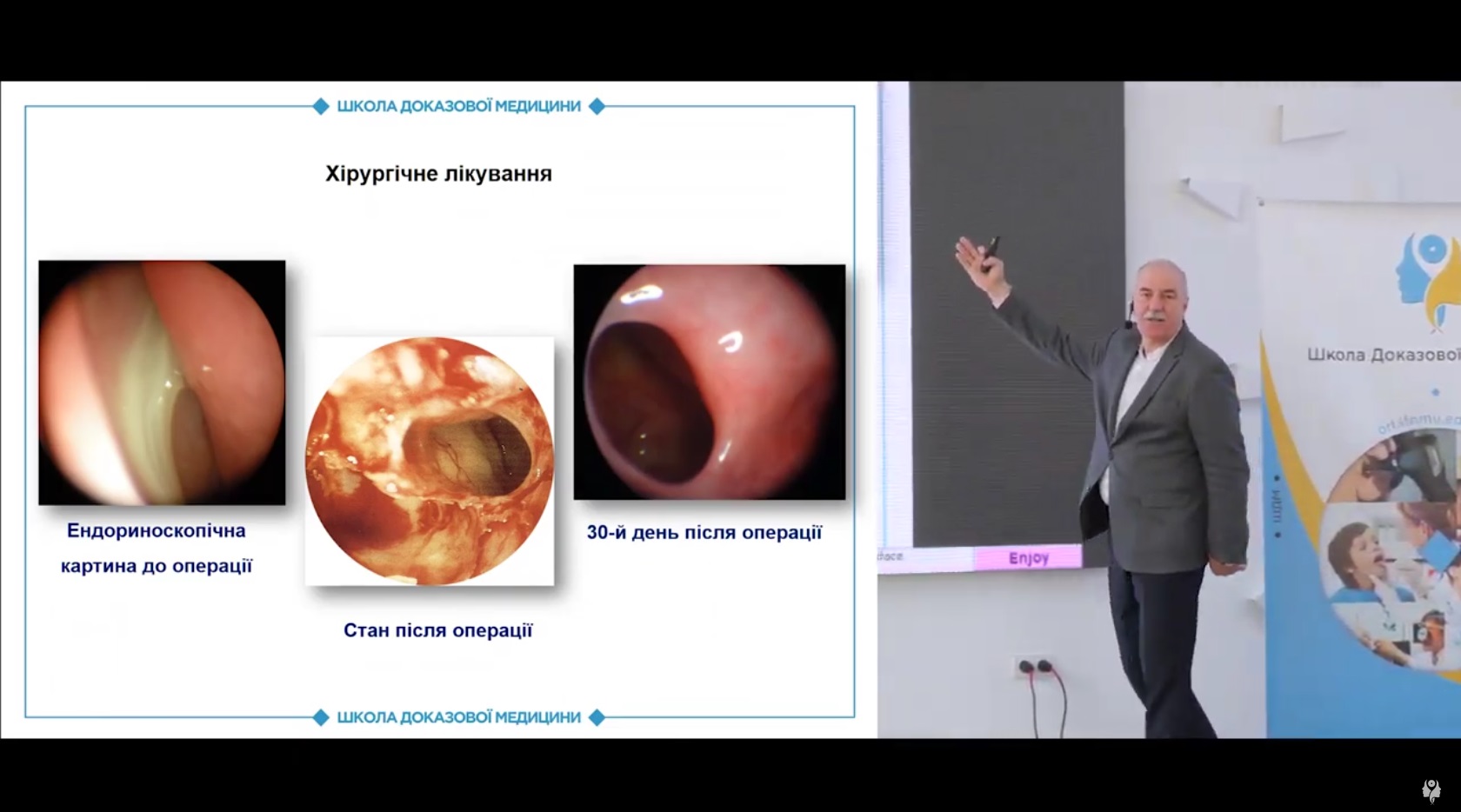 Хірургічне лікування ХРС