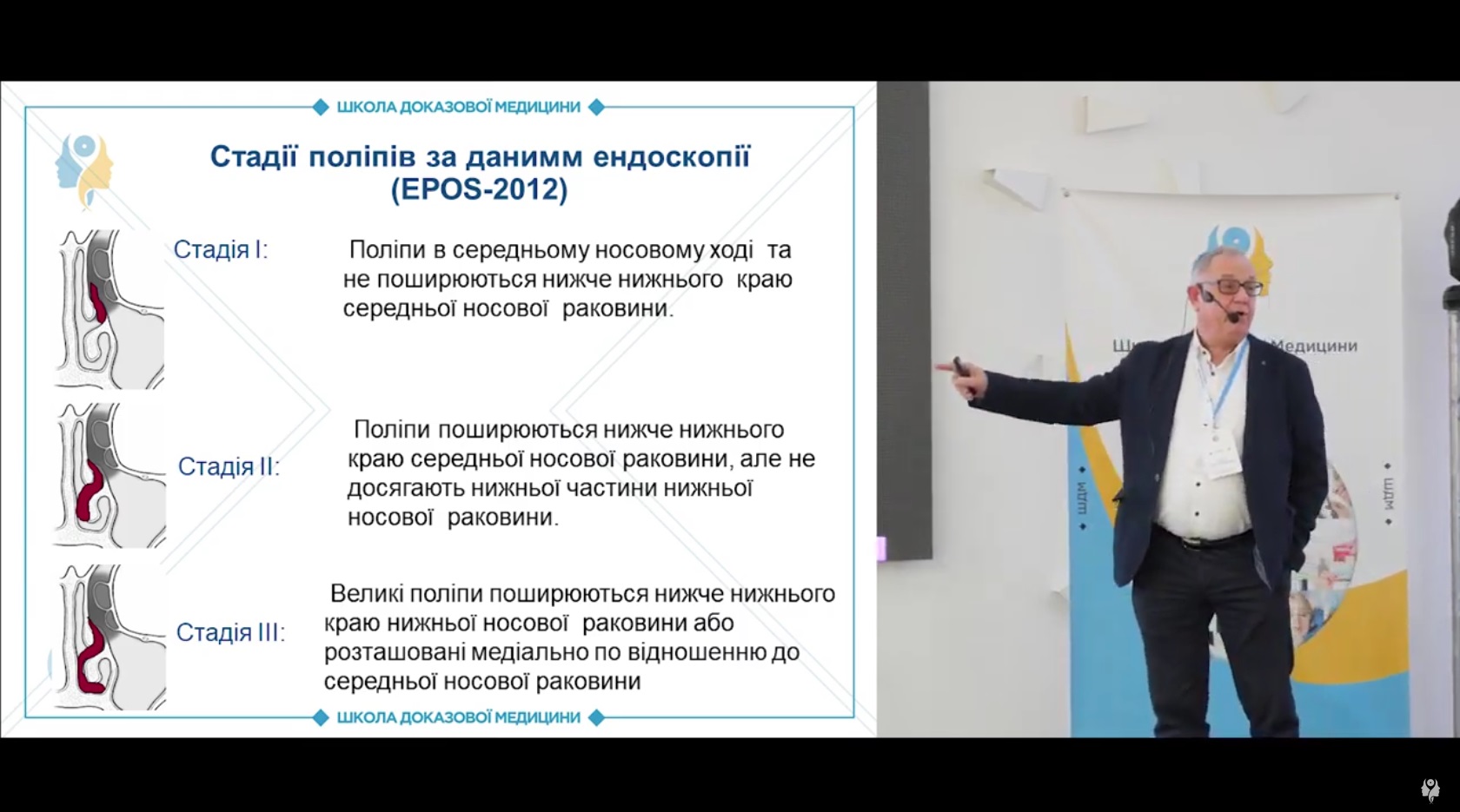 Стадії поліпів за даними ендоскопії (ЕРОS-2012)
