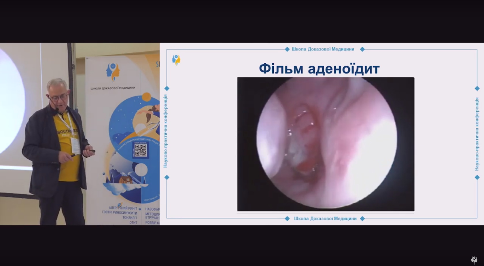 Лікування гострої форми назофарингіту