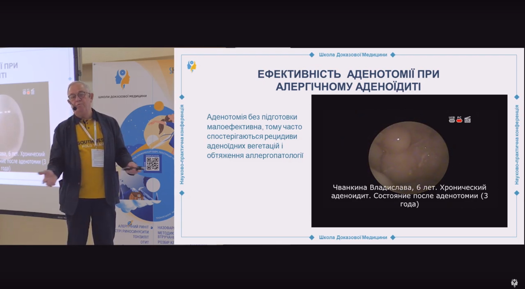 Покази до проведення аденотомії у дітей з алергічним назофарингітом