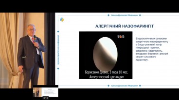 Лікування алергічного назофарингіту згідно принципів обґрунтованої фармакотерапії