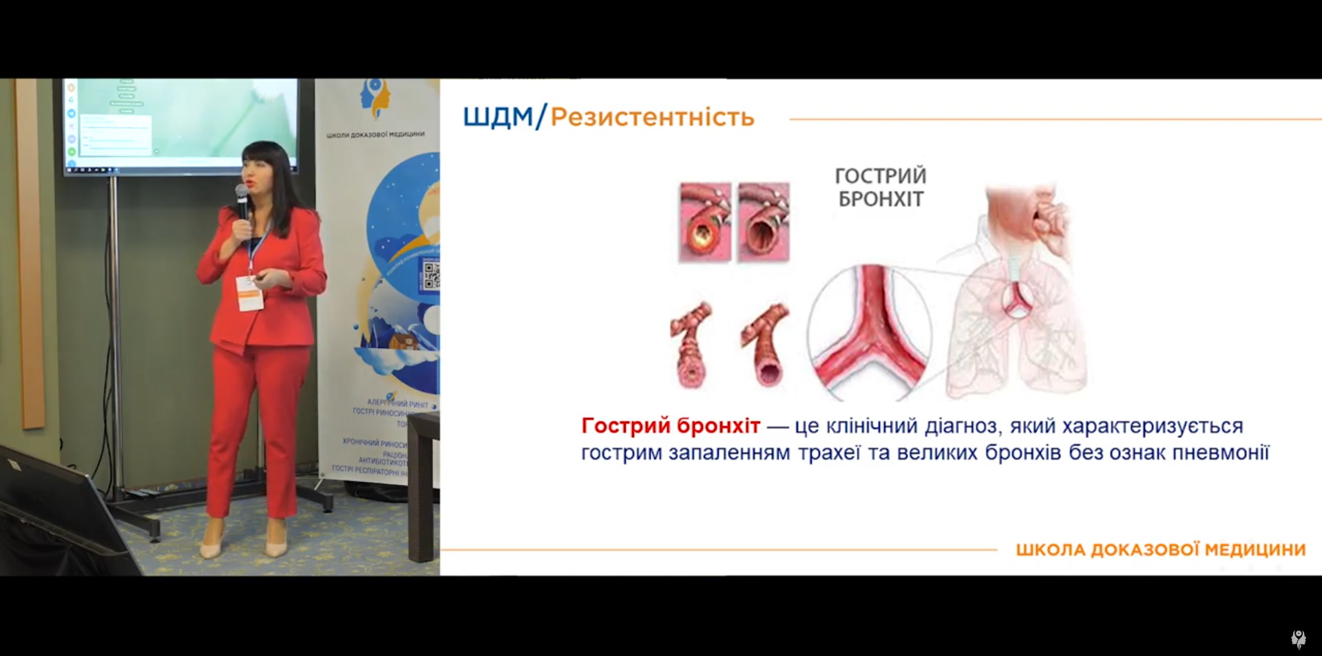 Клінічні ознаки гострого бронхіту