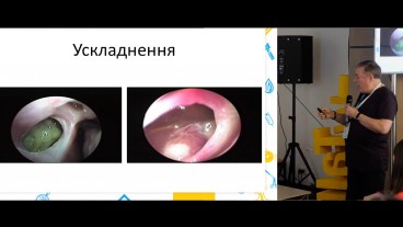 Післяопераційна реабілітація та фармакотерапія при ендоназальних ендоскопічних хірургічних втручання