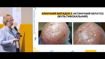 Клінічний випадок: актинічний дерматоз