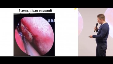 Розбір клінічного випадку «Ускладнення післяопераційного періоду після FESS»