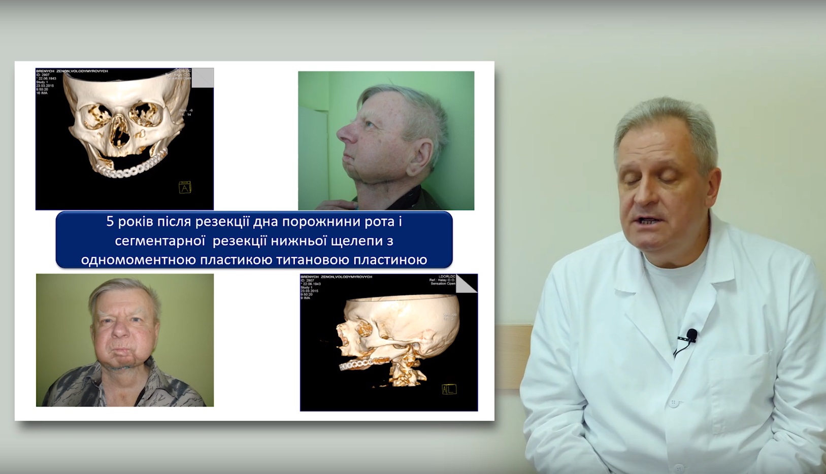 Лікування раку губи та слизової рота. Хірургія. Опромінення. Хіміо- та імунотерапія