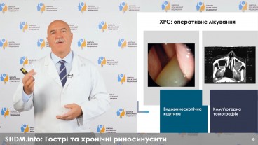 Гострий та хронічний риносинусит. Лікування. Частина третя