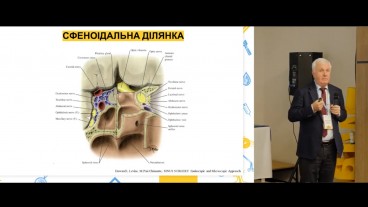 Клінічний випадок: Сфеноітмоїдит+ птоз+втрата зору+негативна пункція – який діагноз?