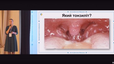 Діагностичні критерії гострого тонзиліту