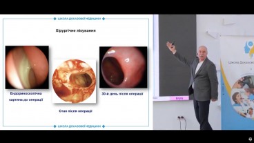 Хірургічне лікування ХРС
