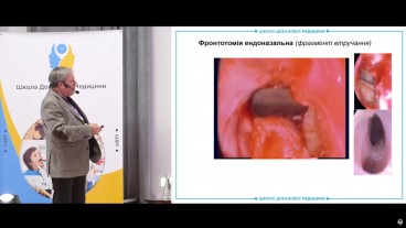 Демонстрація у ретроспективі випадків фронтотомії та сфеноїдотомії