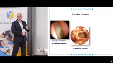 Функціональна ендоскопічна хірургія пазух