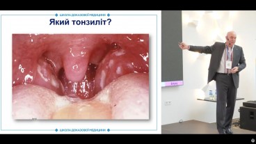 Етіологія та симптоми гострого тонзиліту