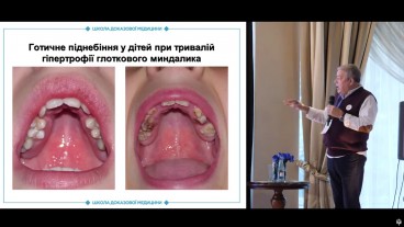 Показання до аденоїдектомії