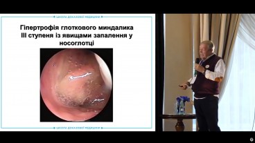 Ознаки гіпертрофії глоткового мигдалика ІІІ ступеня