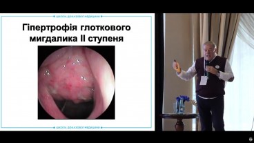 Ознаки гіпертрофії глоткового мигдалика ІІ ступеня