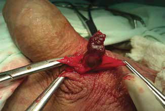 Перев'язка патологічного шунта від статевого члена до лівого насіннєвого канатика